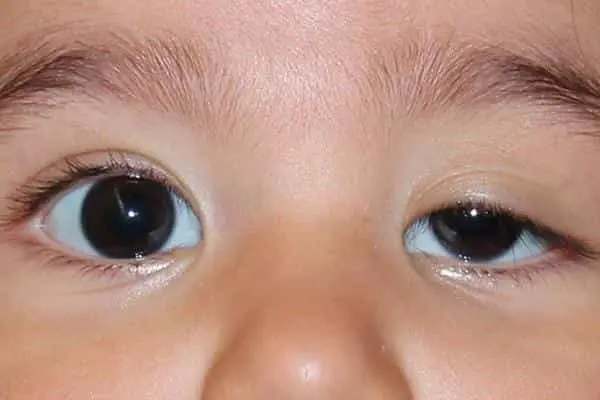 پتوز چشم مادرزادی در کودکان