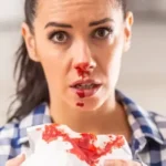 میزان خون از دست رفته بینی در عمل