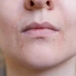 علت لکه‌های خشک روی پوست صورت چیست و باید چکار کنیم؟