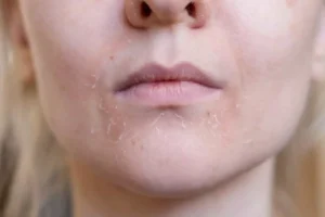 علت لکه‌های خشک روی پوست صورت چیست و باید چکار کنیم؟