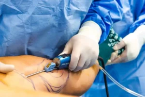 10 تفاوت که بین تکنیکهای مختلف ساکشن وجود دارد