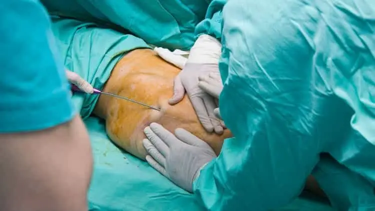 ۱۰ تفاوت که بین تکنیکهای مختلف ساکشن وجود دارد