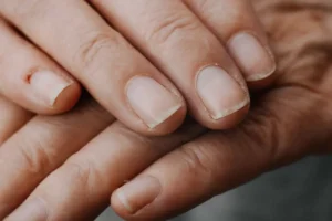 علت پوسته شدن دور ناخن و نحوه خلاص شدن از آن