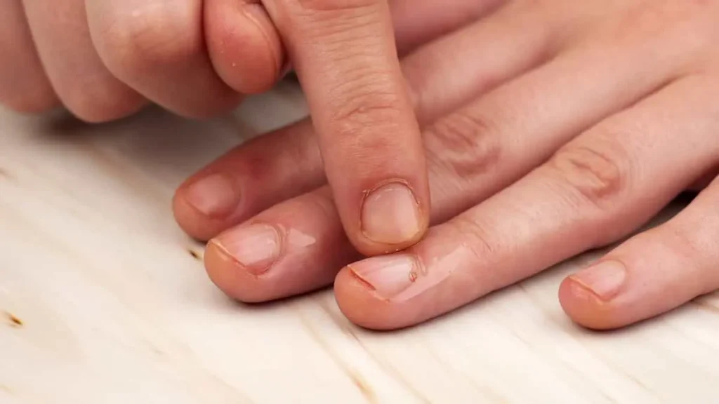 علت پوسته شدن دور ناخن و نحوه خلاص شدن از آن