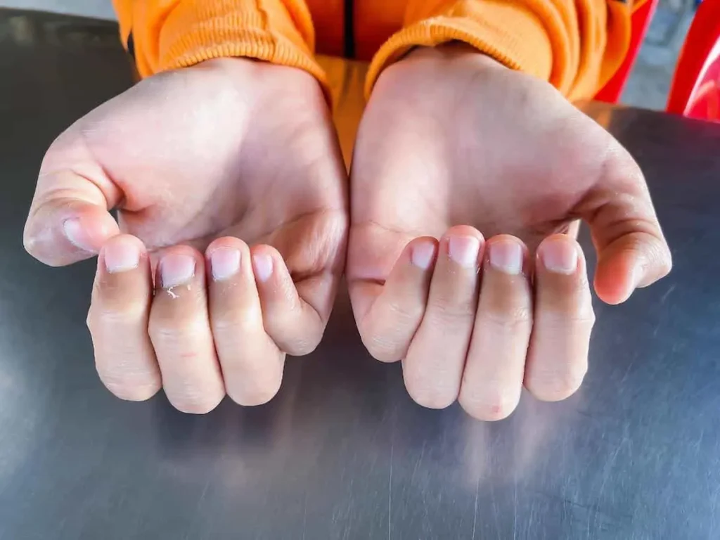 علت پوسته شدن دور ناخن و نحوه خلاص شدن از آن