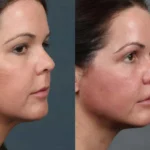 اولتراپی؛ جوانسازی و لیفت پوست بدون نیاز به جراحی