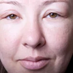 آیا قرص فشار خون باعث ورم بدن می‌شود؟