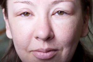 آیا قرص فشار خون باعث ورم بدن می‌شود؟