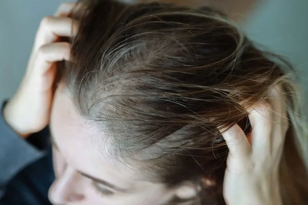 آیا کمبود ویتامین می‌تواند باعث شوره سر شود؟