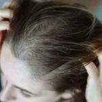 آیا کمبود ویتامین می‌تواند باعث شوره سر شود؟