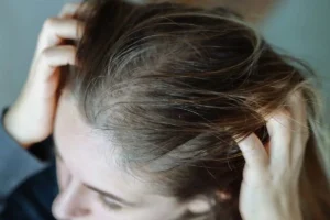 آیا کمبود ویتامین می‌تواند باعث شوره سر شود؟