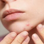 آیا التهاب روده باعث جوش زدن صورت می‌شود؟