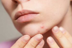 آیا التهاب روده باعث جوش زدن صورت می‌شود؟