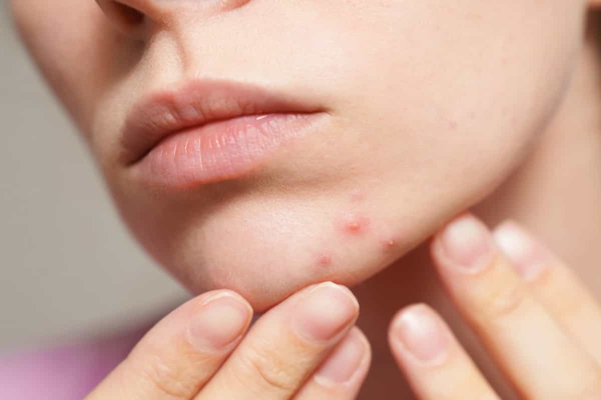 آیا التهاب روده باعث جوش زدن صورت می‌شود؟