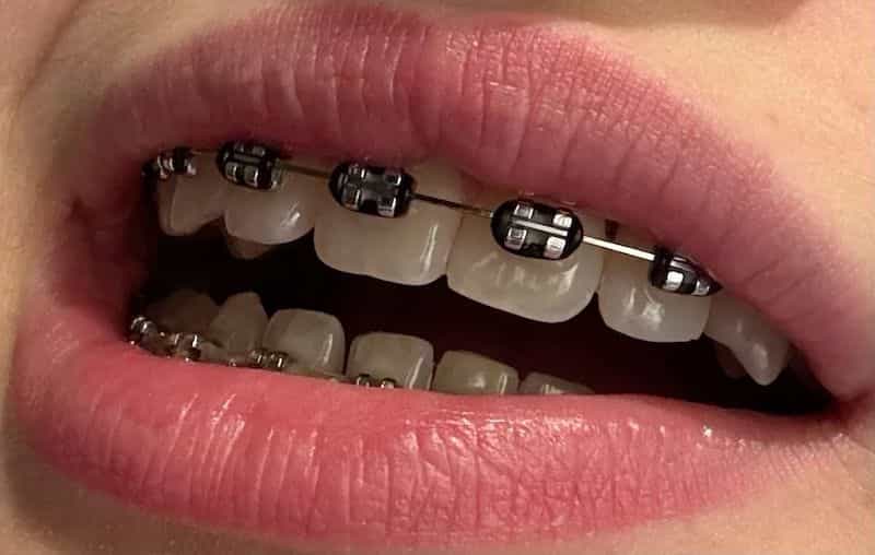 ارتودنسی مشکی؛ مزایا، معایب، تفاوتها و نکات مهم