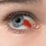 خونریزی چشم دیابتی؛ از اولین نشانه‌ها تا نحوه کنترل و درمان