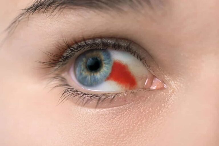 خونریزی چشم دیابتی؛ از اولین نشانهها تا نحوه کنترل و درمان