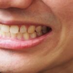 چگونه پلاک‌های دندانی را از بین ببریم؟