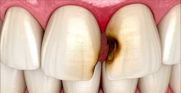پوسیدگی بین دندانی