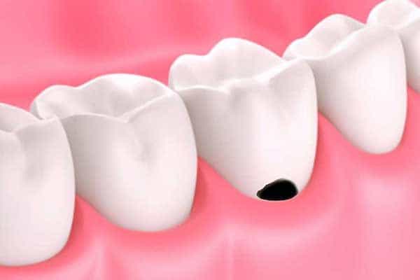 پوسیدگی دندان سطح صاف