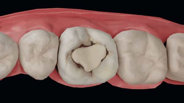 پوسیدگی دندان ثانویه