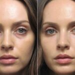 PRP زیر چشم چیست؟ رفع تیرگی، گودی و چروک اطراف چشم