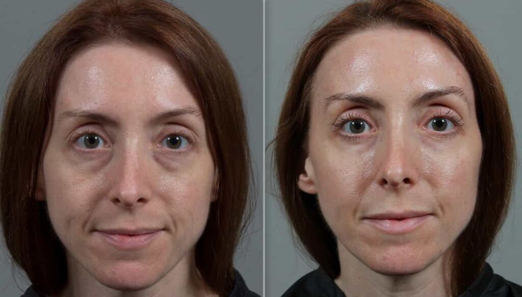 تصویر قبل و بعد از PRP زیر چشم یک زن