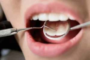 بلیچینگ دندان چقدر دوام دارد؟ بررسی ماندگاری سفیدی دندان