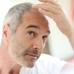 نحوه قطع مصرف ماینوکسیدیل برای جلوگیری از ریزش مجدد