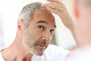 نحوه قطع مصرف ماینوکسیدیل برای جلوگیری از ریزش مجدد