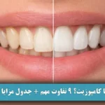 لمینت یا کامپوزیت؟ 9 تفاوت مهم + جدول مزایا و معایب