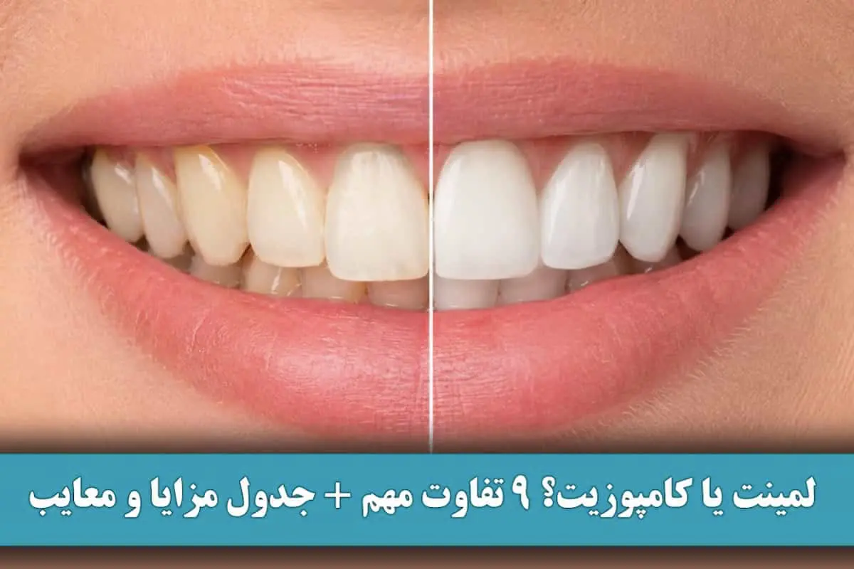 لمینت یا کامپوزیت؟ 9 تفاوت مهم + جدول مزایا و معایب