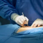 هزینه ابدومینوپلاستی در سال1405 چقدر است؟ بررسی قیمت جراحی شکم و عوامل مؤثر
