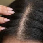 انواع شوره سر؛ تفاوت شوره خشک و چرب و آنچه باید بدانید