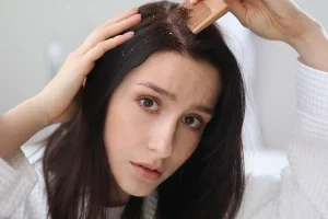 آیا پوسته سر باعث ریزش مو می‌شود؟