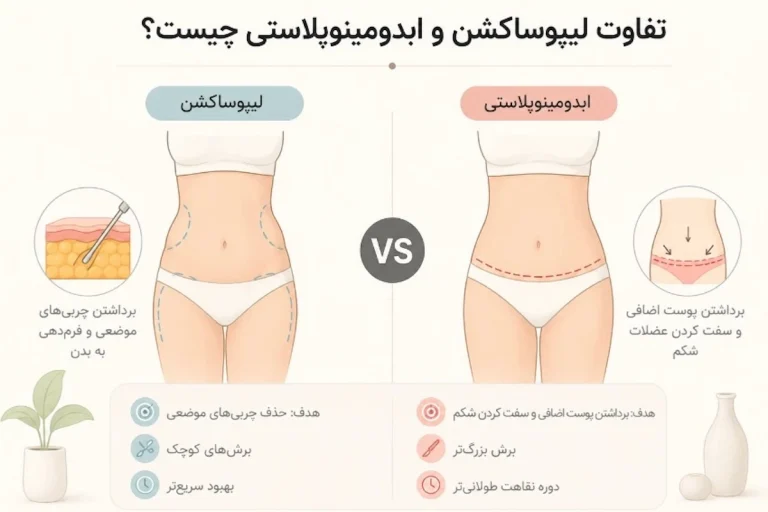تفاوت لیپوساکشن و ابدومینوپلاستی