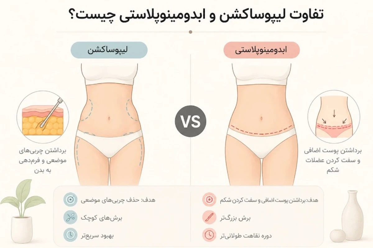 تفاوت لیپوساکشن و ابدومینوپلاستی