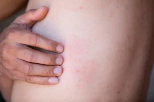 آیا زونا واگیر دارد؟