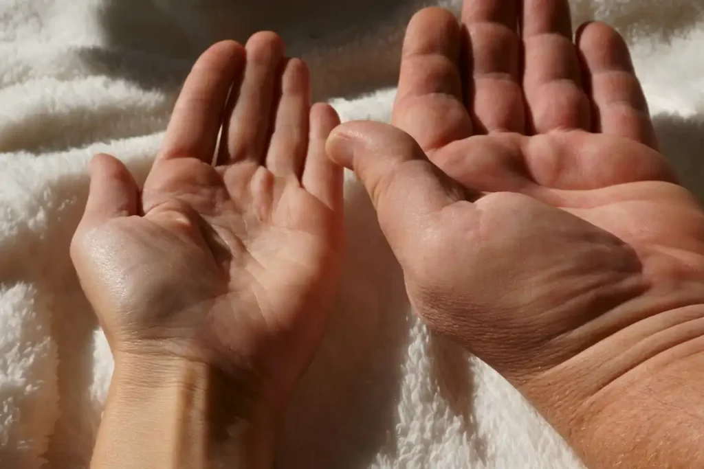 آکرومگالی