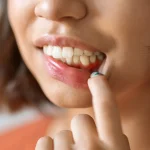 التهاب لثه چیست؟ علائم، علت و درمان