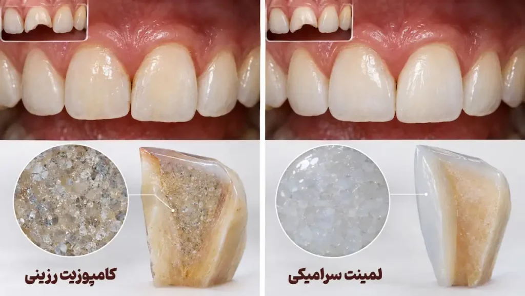 مقایسه کامپوزیت و لمینت برای روش ترمیم دندان شکسته