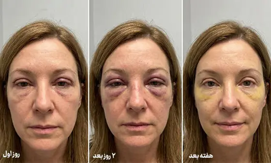 شدت تورم و کبودی در روزهای بعد از جراحی