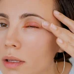 چطور گل مژه را سریع درمان کنیم؟