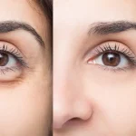 فیلر زیر چشم؛ کاربردها، نحوه تزریق، ماندگاری، مزایا و عوارض