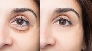 فیلر زیر چشم؛ کاربردها، نحوه تزریق، ماندگاری، مزایا و عوارض