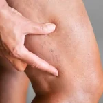 علت بروز واریس و روش‌های پیشگیری از آن