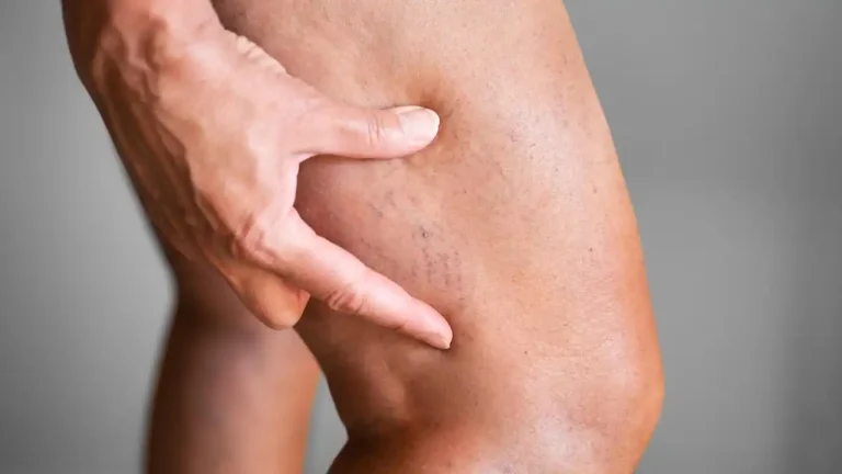 علت بروز واریس و روشهای پیشگیری از آن